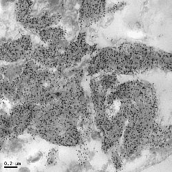 Beta-Amyloid Plaque in Alzheimer's Disease Brain
