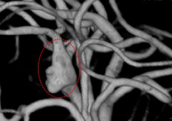 A 3D reconstruction of an angiogram showing the aneurysm circled in red. Credit: University of Sussex