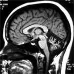 MRI scan showing brain shrinkage caused by genetic disease