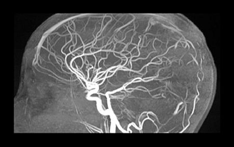 Brain scan