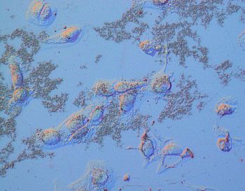 Bone carcinoma on thin molybdenum disulfide substrate