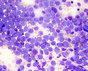 AML bone marrow