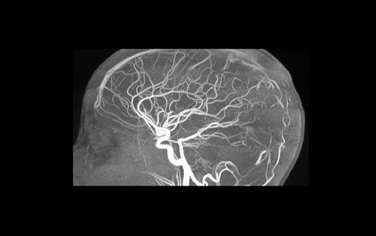 MRI angiogram image of human brain