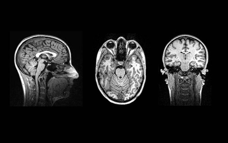 MRI structural image of human brain
