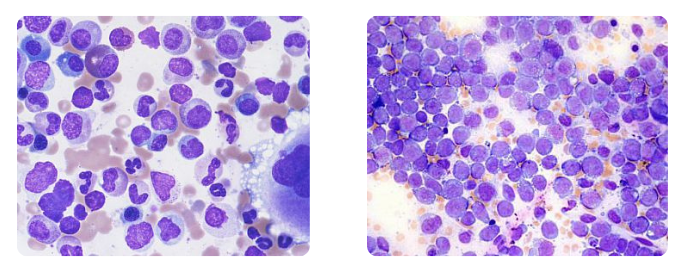 Normal bone marrow aspirate from a healthy donor (left) AML Bone marrow aspirate with myeloid leukaemia (right)